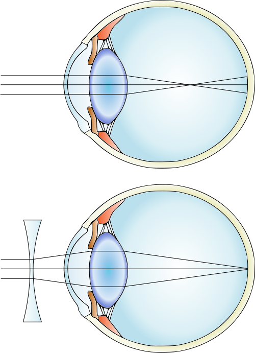 Myopia and lens correction
